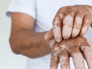 Vitiligo Treatment