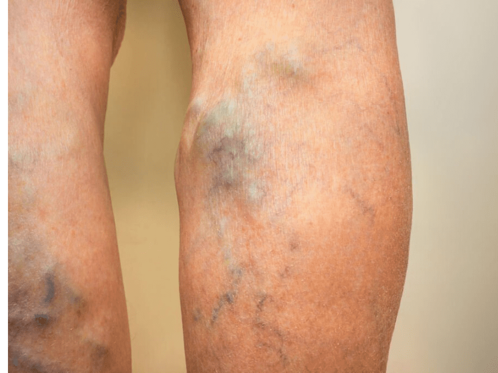 Best varicose vein Specialist Doctor in Nagpur