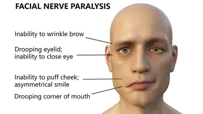 facial paralysis