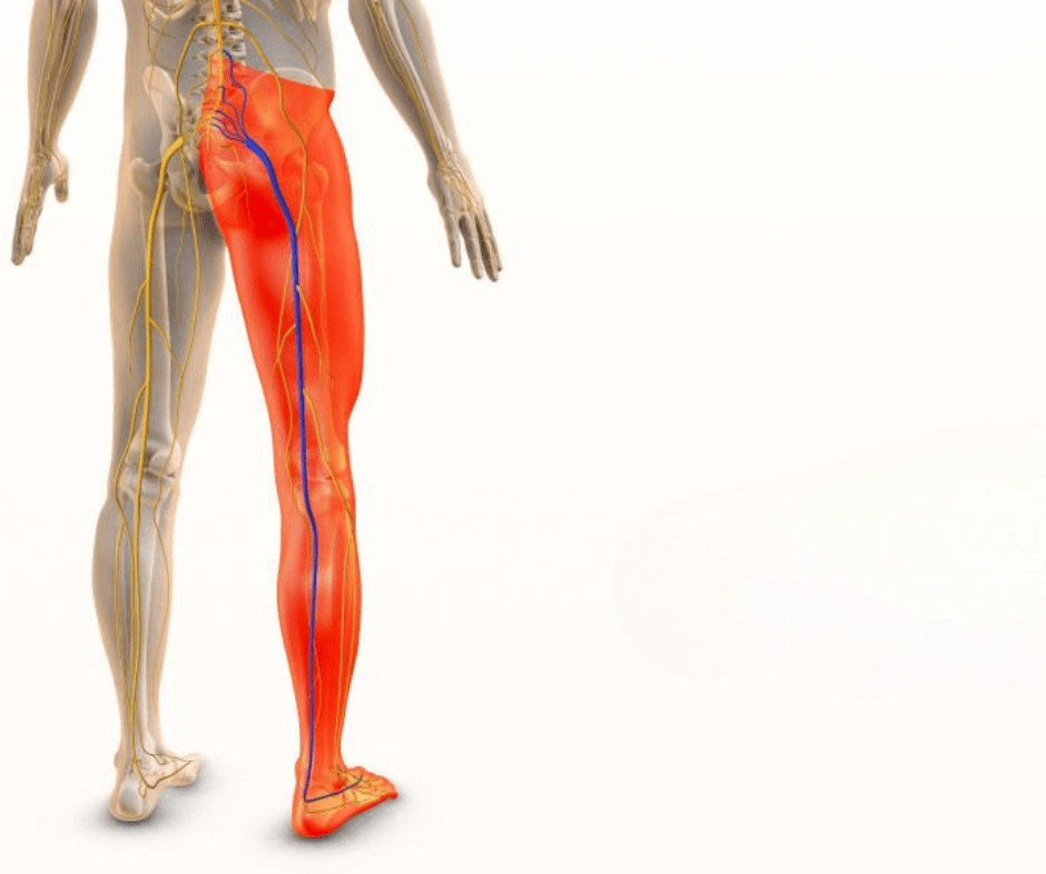 sciatica Treatment