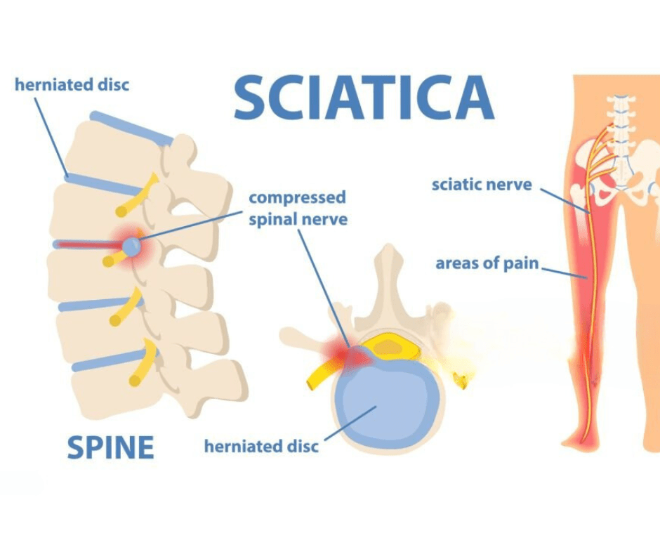 Sciatica Treatment